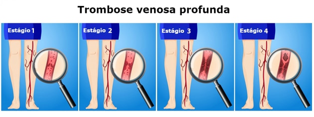 trombosis venosa