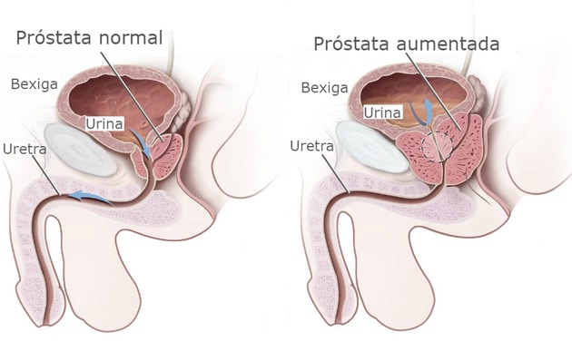 agrandamiento de la próstata