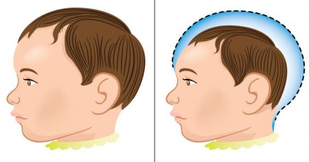 Niño normal y uno con microcefalia.  Ilustración: Luciano Cosmo / Shutterstock.com