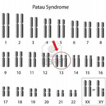 Cariotipo del síndrome de Patau