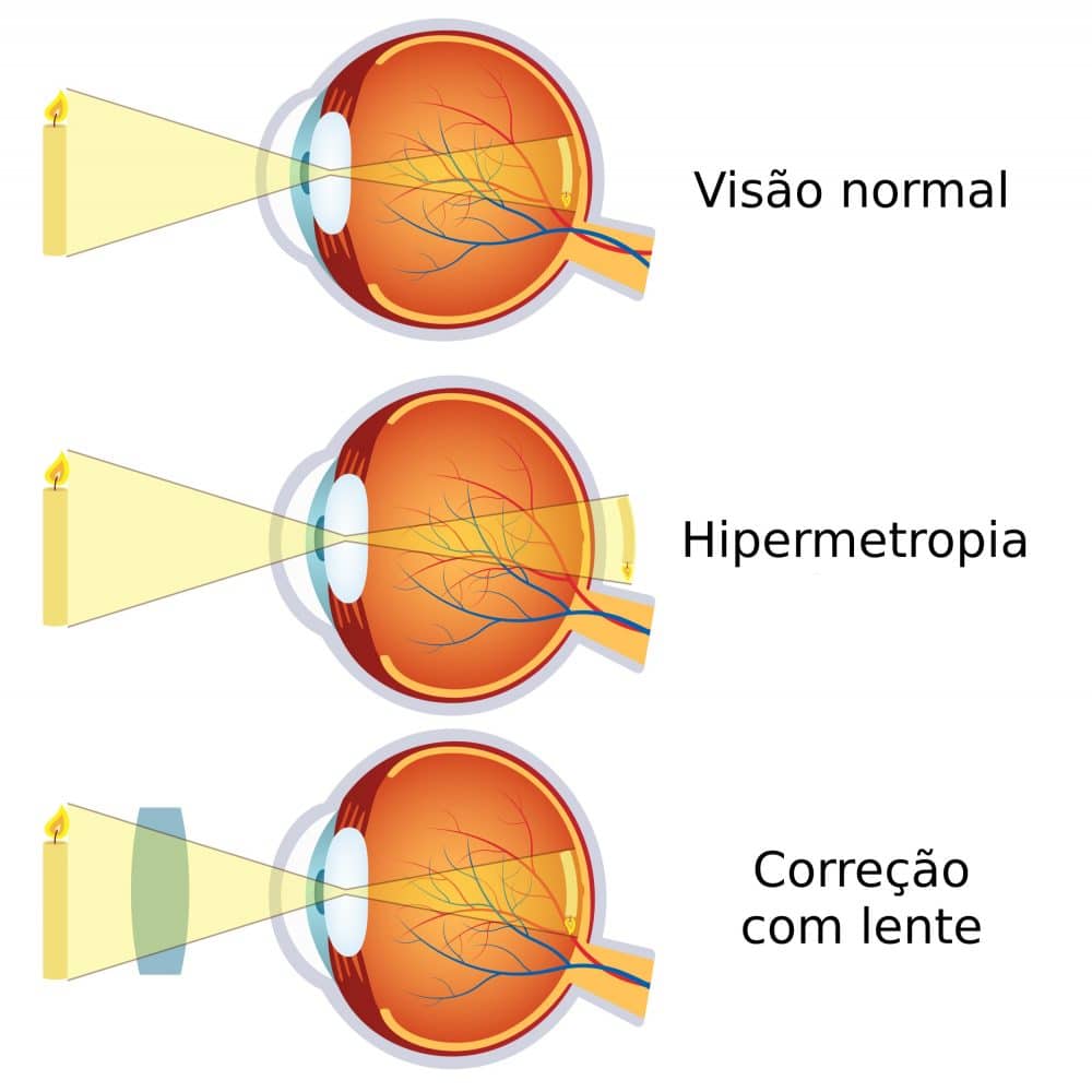 dacă miopie și hipermetropie în același timp Sunătoarea afectează vederea