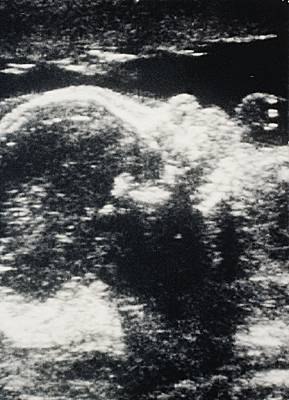 Ecografía del feto de ocho meses