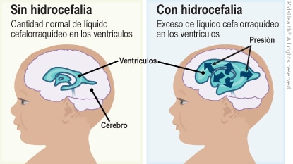hidrocefalia –